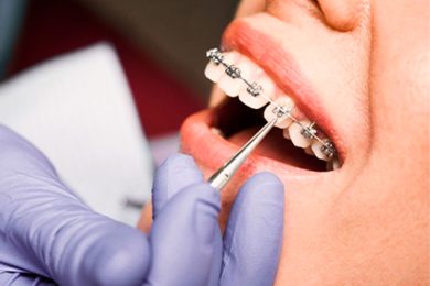 Aparelhos Ortodônticos – Indaial – Santa Catarina – Neo Prime Odontologia Aparelhos Ortodônticos - Indaial - Santa Catarina - Neo Prime Odontologia