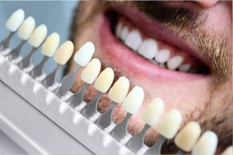 Facetas Dentárias – Indaial – Santa Catarina – Neo Prime Odontologia Facetas Dentárias - Indaial - Santa Catarina - Neo Prime Odontologia