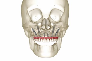 Neo-prime-odontologia-implantes-zigomatico