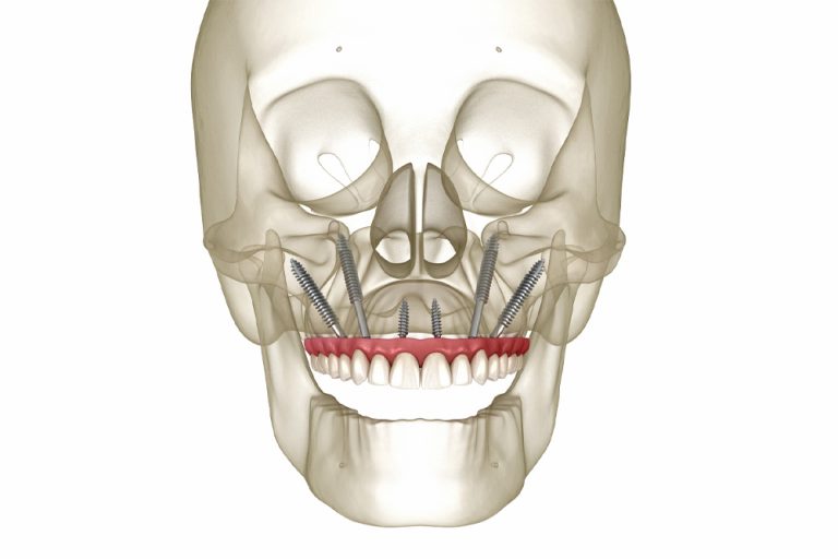 Neo-prime-odontologia-implantes-zigomatico